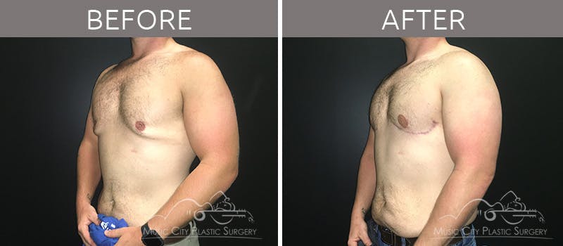 Gynecomastia Before & After Gallery - Patient 90709219 - Image 3