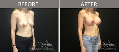 Breast Lift Before & After Gallery - Patient 90709220 - Image 2
