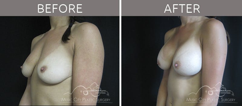 Breast Augmentation Before & After Gallery - Patient 90709231 - Image 2