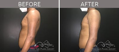 Gynecomastia Before & After Gallery - Patient 90709230 - Image 1