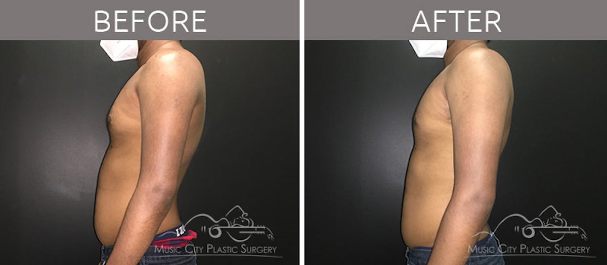 Gynecomastia Before & After Gallery - Patient 90709230 - Image 1