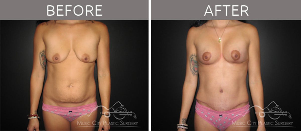 Mommy Makeover Before & After Gallery - Patient 90709229 - Image 1