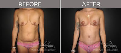 Mommy Makeover Before & After Gallery - Patient 90709229 - Image 1