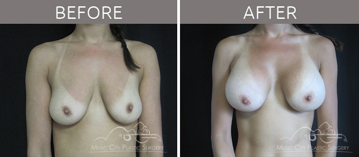 Breast Augmentation Before & After Gallery - Patient 90709231 - Image 1