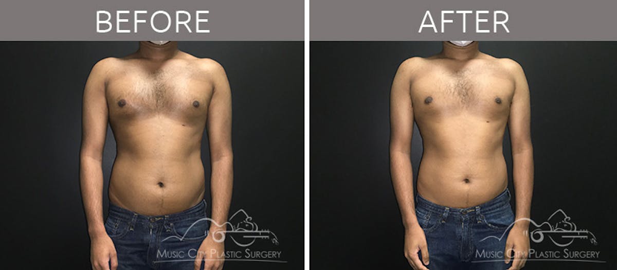 Gynecomastia Before & After Gallery - Patient 90709230 - Image 2