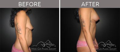 Mommy Makeover Before & After Gallery - Patient 90709229 - Image 2