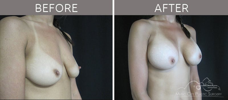 Breast Augmentation Before & After Gallery - Patient 90709231 - Image 4