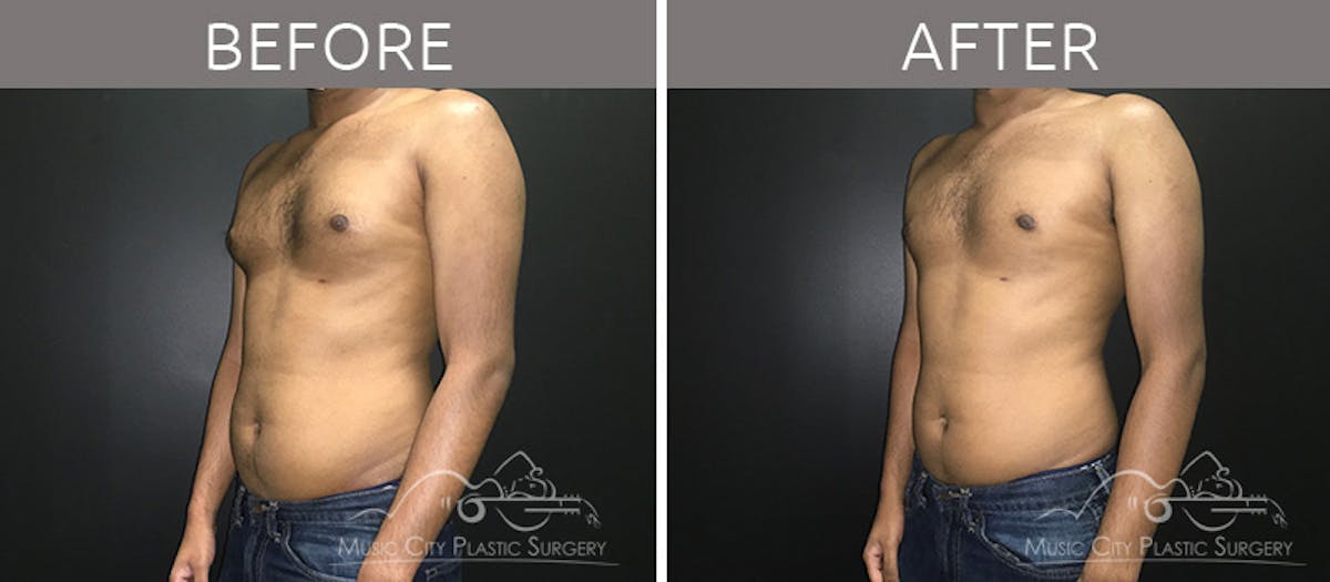 Gynecomastia Before & After Gallery - Patient 90709230 - Image 3