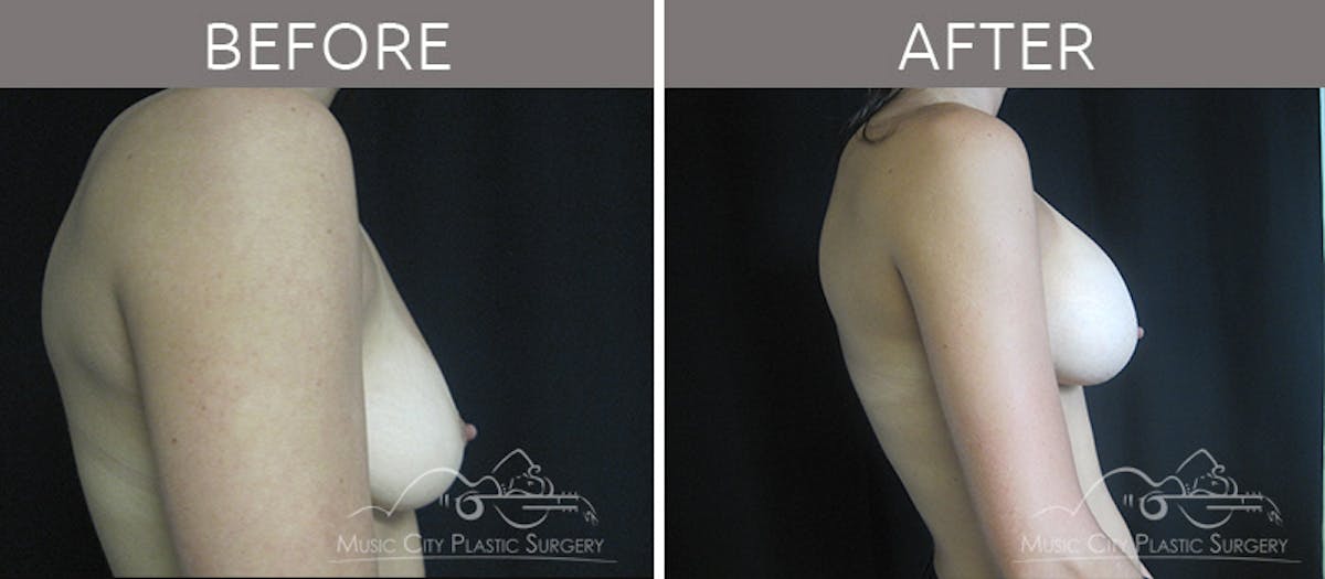 Breast Augmentation Before & After Gallery - Patient 90709231 - Image 5