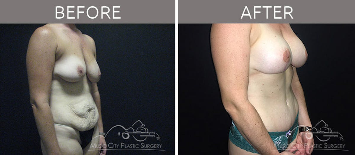 Breast Lift with Augmentation Before & After Gallery - Patient 132099619 - Image 2