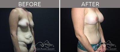Breast Lift with Augmentation Before & After Gallery - Patient 132099619 - Image 2