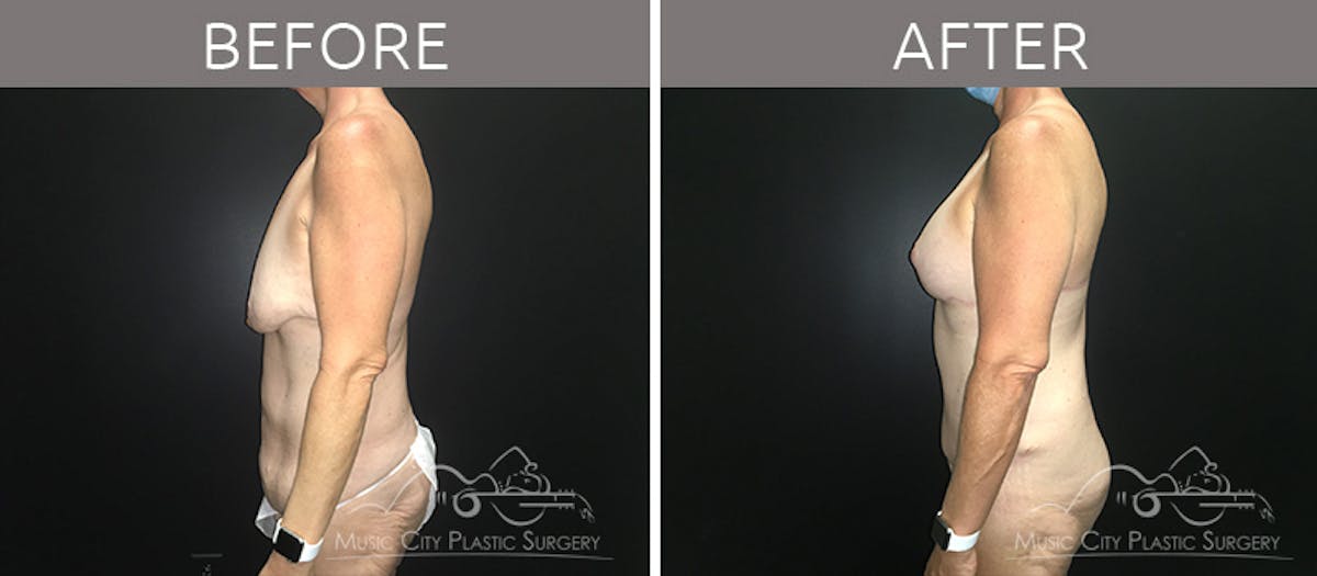 Mommy Makeover Before & After Gallery - Patient 90709244 - Image 3