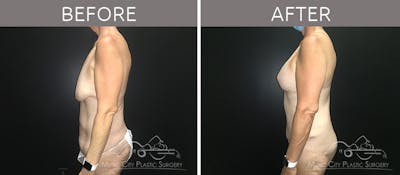 Mommy Makeover Before & After Gallery - Patient 90709244 - Image 3