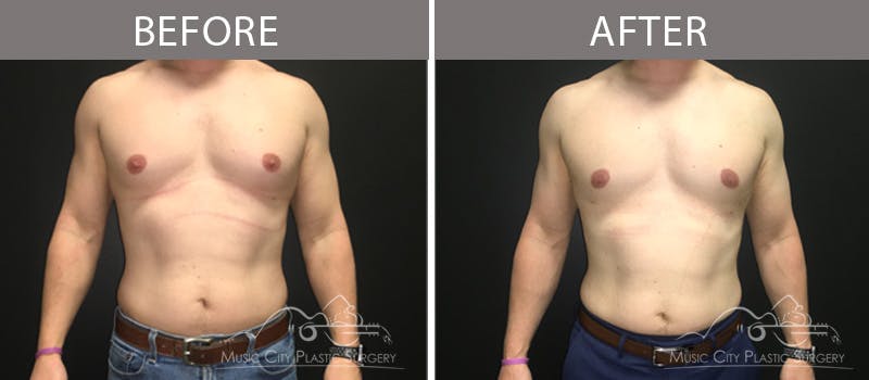 Gynecomastia Before & After Gallery - Patient 90709235 - Image 1