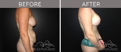 Breast Lift with Augmentation Before & After Gallery - Patient 132099619 - Image 3