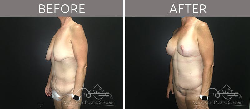 Mommy Makeover Before & After Gallery - Patient 90709244 - Image 2