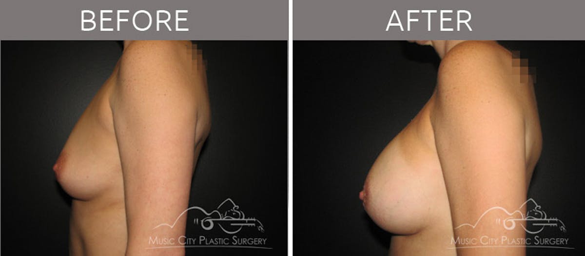 Breast Augmentation Before & After Gallery - Patient 90709236 - Image 3
