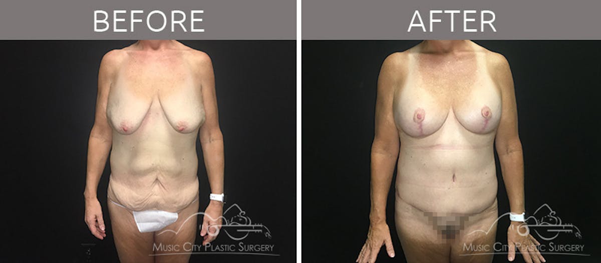 Mommy Makeover Before & After Gallery - Patient 90709244 - Image 1