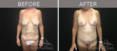 Mommy Makeover Before & After Gallery - Patient 90709244 - Image 1
