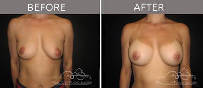 Breast Augmentation Before & After Gallery - Patient 90709236 - Image 1