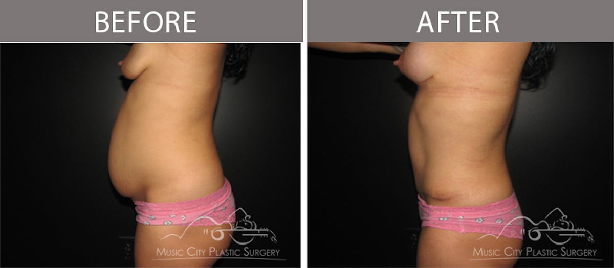 Breast Lift Before & After Gallery - Patient 90709245 - Image 3