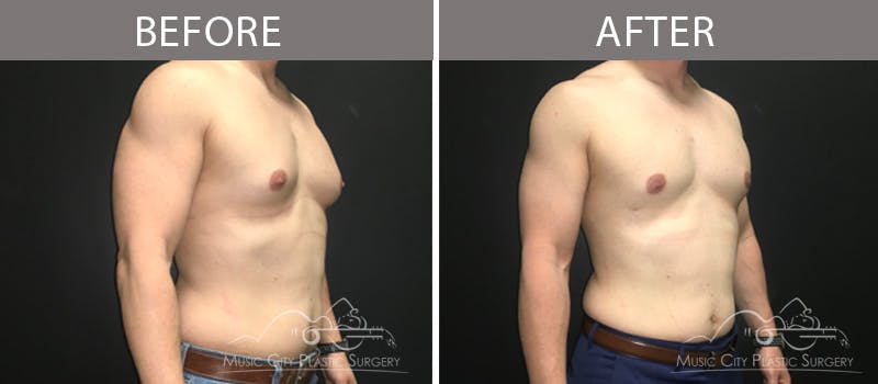 Gynecomastia Before & After Gallery - Patient 90709235 - Image 3