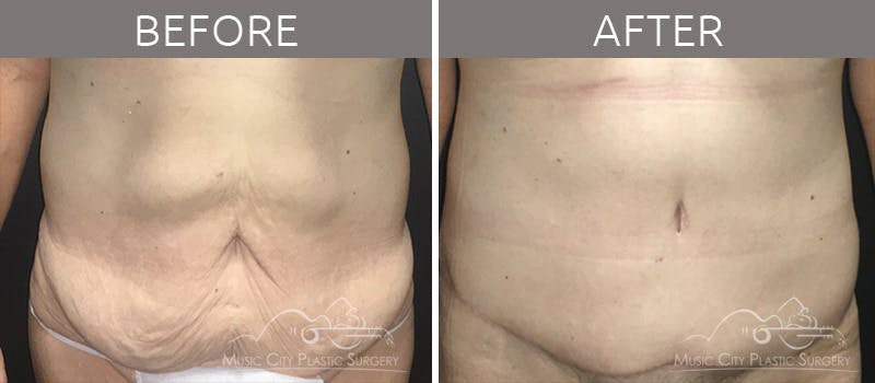 Mommy Makeover Before & After Gallery - Patient 90709244 - Image 4