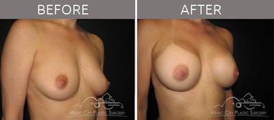 Breast Augmentation Before & After Gallery - Patient 90709236 - Image 2