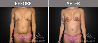 Breast Lift Before & After Gallery - Patient 90709245 - Image 1