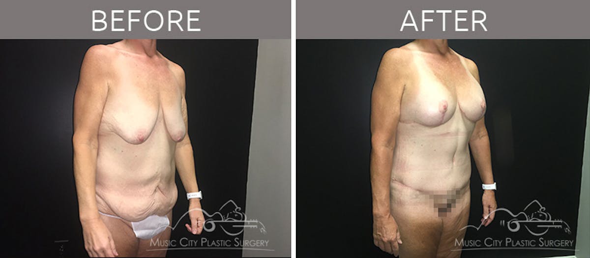 Mommy Makeover Before & After Gallery - Patient 90709244 - Image 5