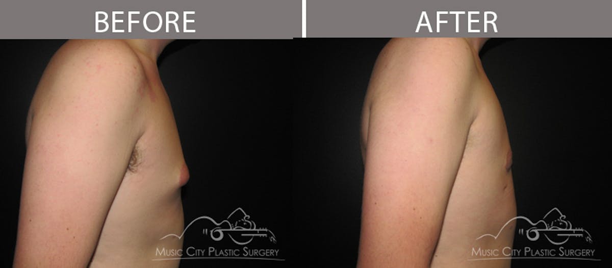 Gynecomastia Before & After Gallery - Patient 90709246 - Image 1