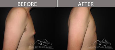 Gynecomastia Before & After Gallery - Patient 90709246 - Image 1