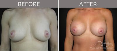 Breast Augmentation Before & After Gallery - Patient 90709247 - Image 1