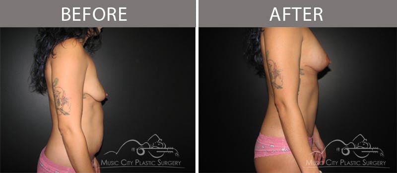Breast Lift Before & After Gallery - Patient 90709245 - Image 3