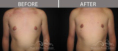 Gynecomastia Before & After Gallery - Patient 90709246 - Image 2