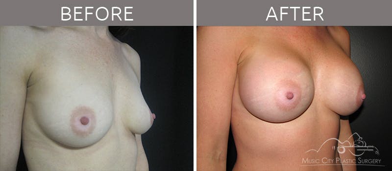Breast Augmentation Before & After Gallery - Patient 90709247 - Image 2