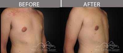 Gynecomastia Before & After Gallery - Patient 90709246 - Image 3