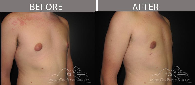 Gynecomastia Before & After Gallery - Patient 90709246 - Image 3