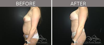 Mommy Makeover Before & After Gallery - Patient 90709253 - Image 3