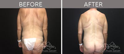Breast Lift with Augmentation Before & After Gallery - Patient 132099617 - Image 1