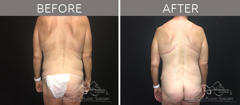Breast Lift with Augmentation Before & After Gallery - Patient 132099617 - Image 1