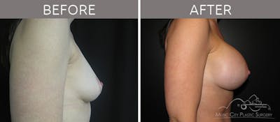 Breast Augmentation Before & After Gallery - Patient 90709247 - Image 3