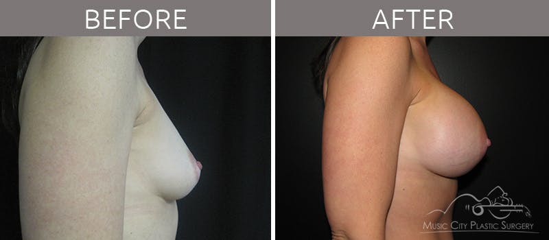 Breast Augmentation Before & After Gallery - Patient 90709247 - Image 3