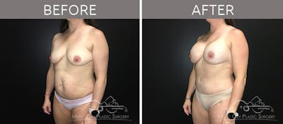 Mommy Makeover Before & After Gallery - Patient 90709253 - Image 2