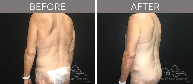Breast Lift with Augmentation Before & After Gallery - Patient 132099617 - Image 2