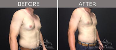 Gynecomastia Before & After Gallery - Patient 90709249 - Image 1