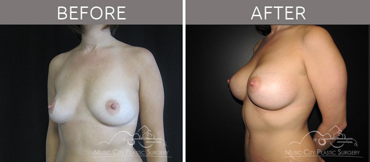 Breast Augmentation Before & After Gallery - Patient 90709250 - Image 2