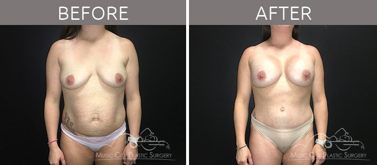 Mommy Makeover Before & After Gallery - Patient 90709253 - Image 1