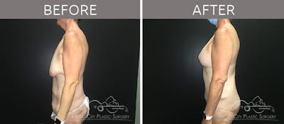 Breast Lift with Augmentation Before & After Gallery - Patient 132099617 - Image 3