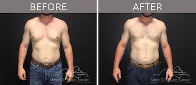 Gynecomastia Before & After Gallery - Patient 90709249 - Image 2